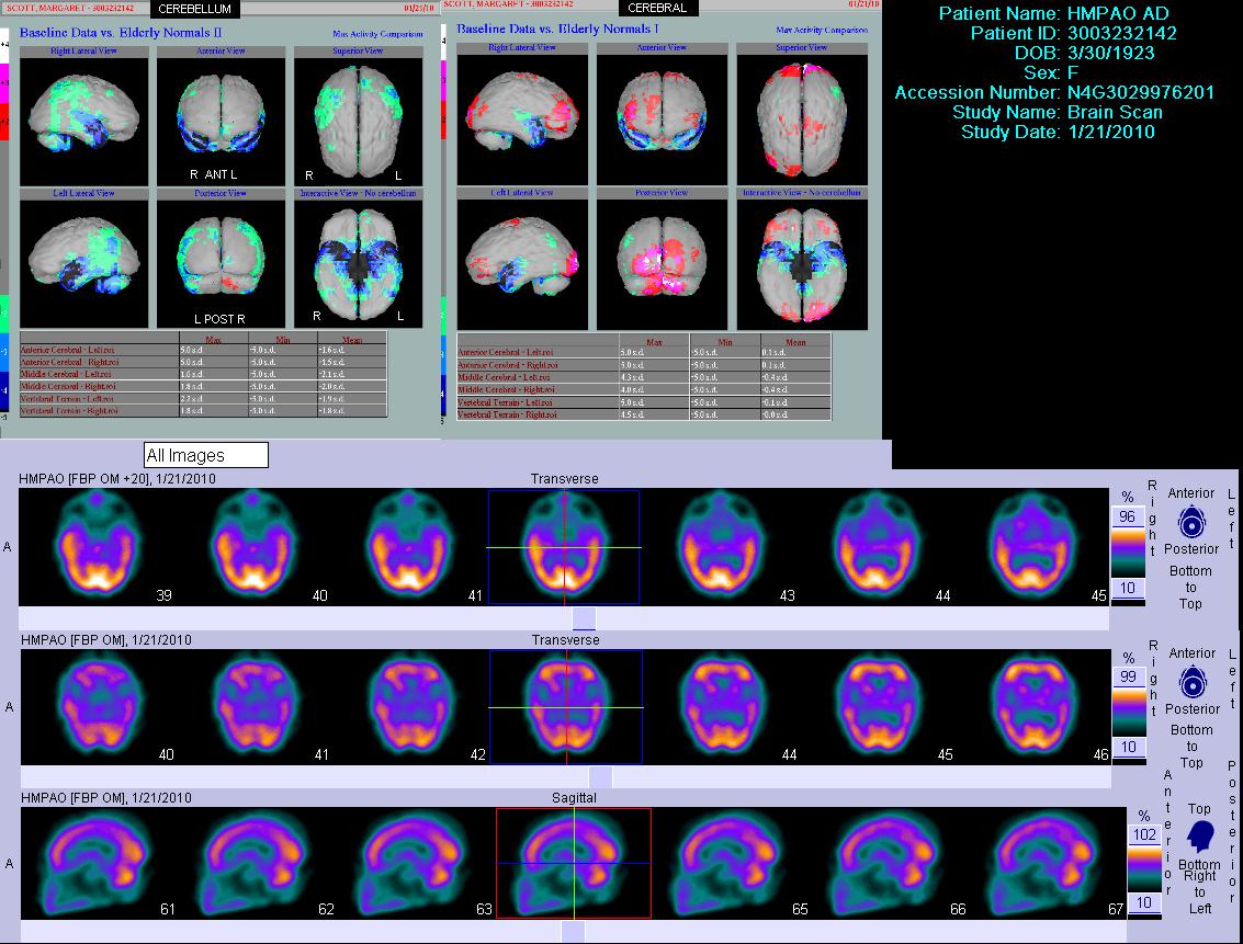 regional cerebral blood flow single photon emission computed tomography (rCBF SPECT) showing typical temporoparietal perfusion deficits in Alzheimer's disease
