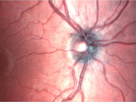 Laser scanning ophthalmoscope image of the retina