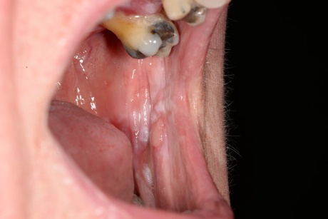 Oral lichen planus on the inside of the left cheek