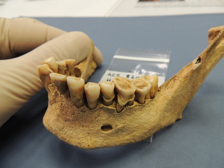 Late Iron Age/Roman woman showing large dental calculus deposit, from Cambridge area | Credit: Alan Cooper