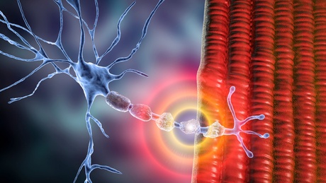 Demyelination of neuron, the damage of the neuron myelin sheath seen in demyelinating diseases, 3D illustration