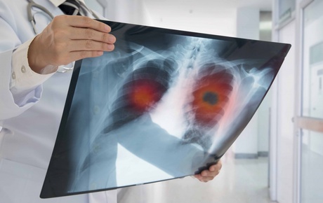The Early detection of Cancer of the Lung Scotland trial has shown a combination of blood tests followed by CT scanning can help detect lung cancer earlier