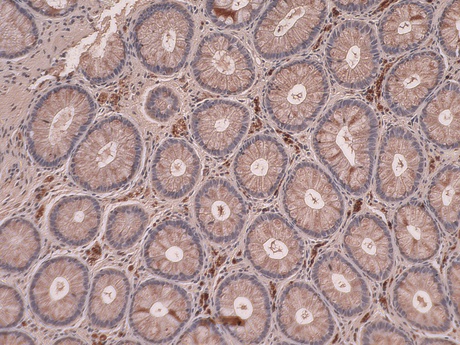 An image of the gut biopsy stained in the lab with the marker that allows the team to predict risk of neurological symptoms
