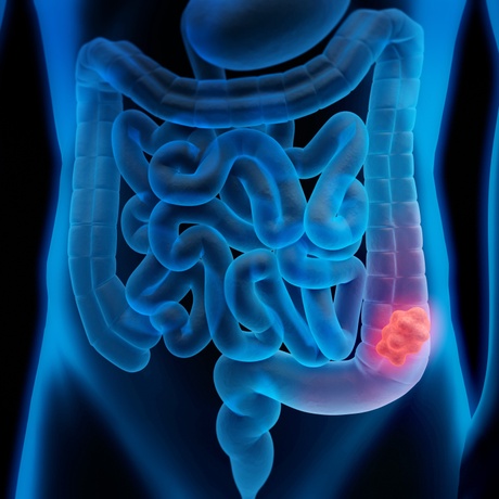 Graphic of a bowel