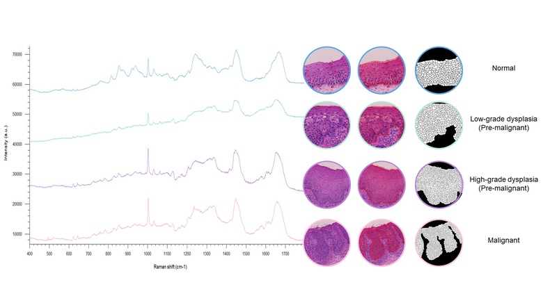 We used Raman spectroscopy on histopathological tissue sections from the oral cavity to identify biochemical differences between normal, low grade dysplasia (LGD), high grade dysplasia (HGD) and squamous cell carcinoma (SCC). The left panel shows example Raman spectra. We also used microscopy images to discern morphological differences between automatically detected cells from the different diagnostic groups (right panel).