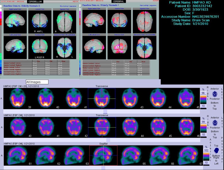 regional cerebral blood flow single photon emission computed tomography (rCBF SPECT) showing typical temporoparietal perfusion deficits in Alzheimer’s disease