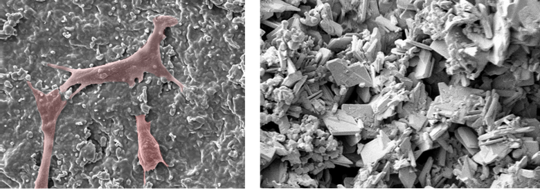 left: Scanning electron microscope image of cells attached to the surface of a chemically modified calcium phosphate. The cells have been artificially coloured to provide contrast against the surface structure of the calcium phosphate., right: Scanning electron microscope image of the fracture surface of a calcium phosphate bone cement.
