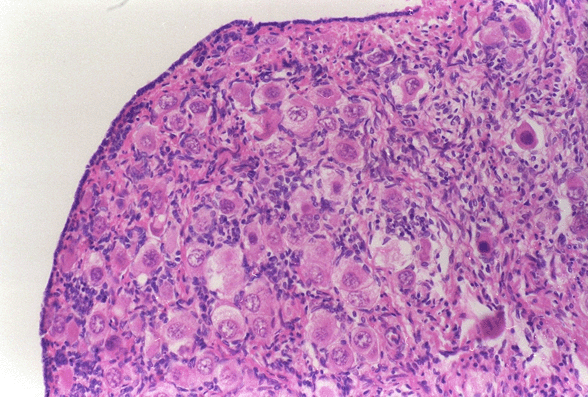 Micrograph of Child's Ovary