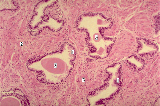 Micrograph of Prostate