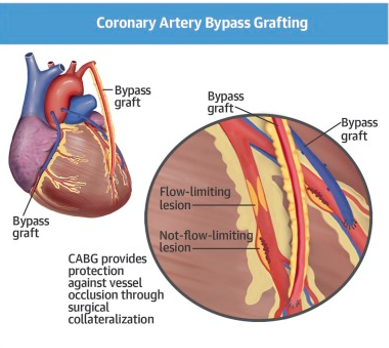 Coronary Artery Bypass Grafting