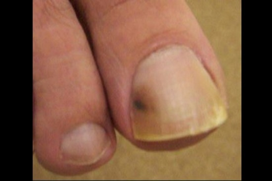 Is the Black Line on Your Nail Normal or Melanoma? How To tell