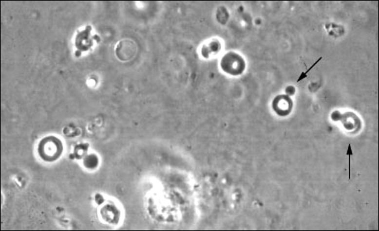 Microscopic Haematuria