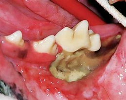 photo of mouth showing exposed Osteomyelitis