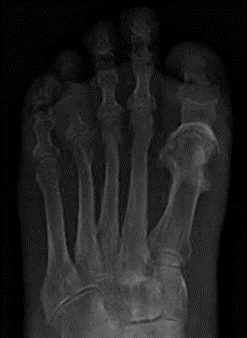 x-ray of foot showing swollen joint / Osteomyelitis