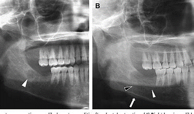 x-ray of mouth showing Osteomyelitis