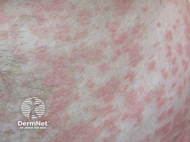Viral Exanthema 1 A Woman With A Morbilliform Rash
